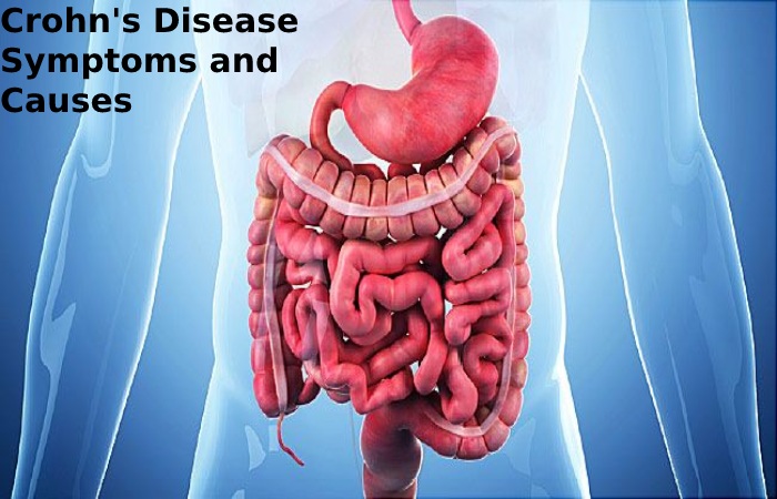 Crohn's Disease