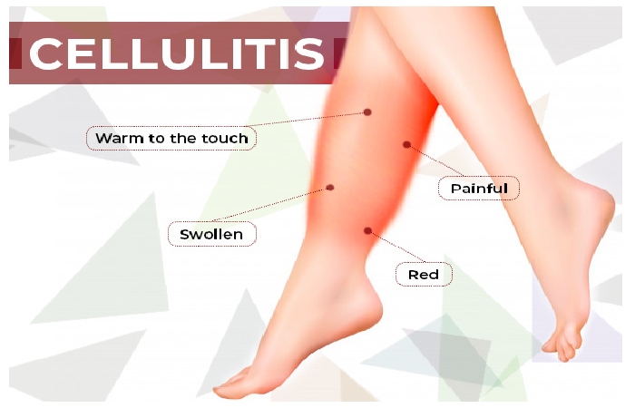 Cellulitis 