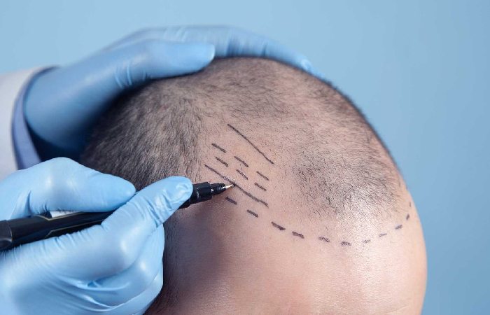 Hair Transplant