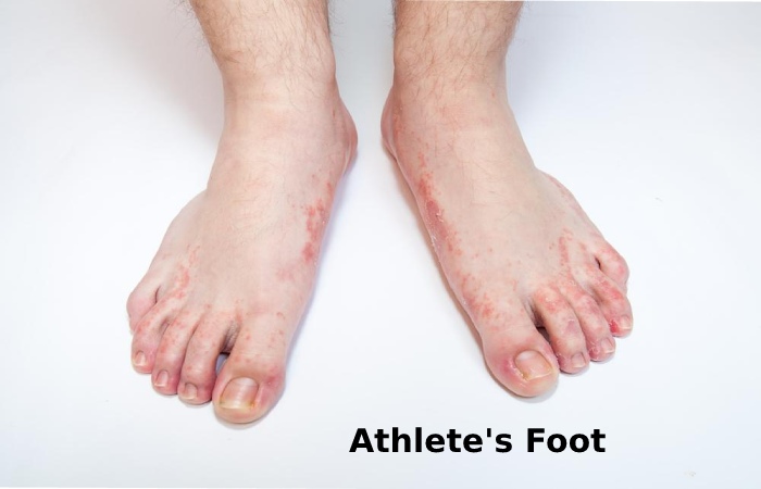 Athlete's Foot