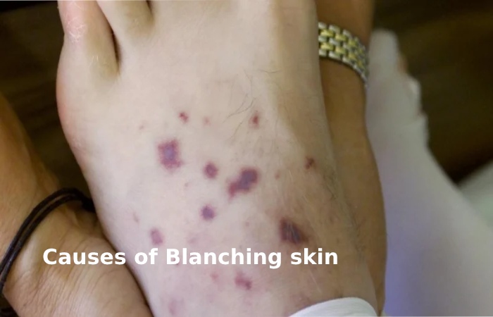 Causes of Blanching skin