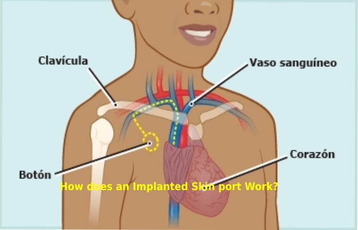 How does an Implanted Skin port Work_