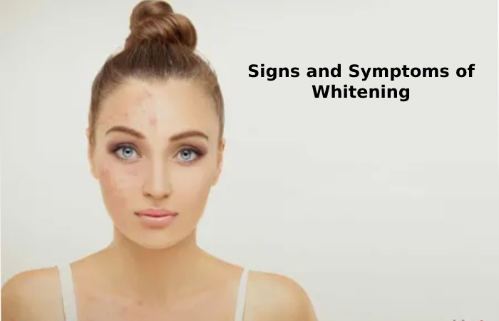 Signs and Symptoms of Whitening