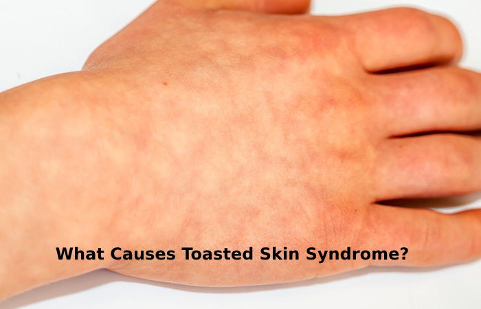 What Causes Toasted Skin Syndrome_